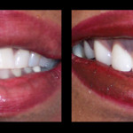 Cosmetic Dentist Hollywood Smile Gallery 16