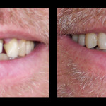 Cosmetic Dentist Hollywood Smile Gallery 18