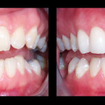 Cosmetic Dentist Hollywood Smile Gallery 21