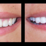 Cosmetic Dentist Hollywood Smile Gallery 22