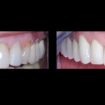 Cosmetic Dentist Hollywood Smile Gallery 23