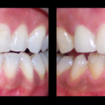 Cosmetic Dentist Hollywood Smile Gallery 24