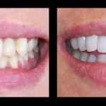 Cosmetic Dentist Hollywood Smile Gallery 28