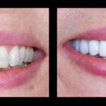 Cosmetic Dentist Hollywood Smile Gallery 5