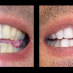 Cosmetic Dentist Hollywood Smile Gallery 9