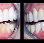 Cosmetic Dentist Hollywood Smile Gallery 1