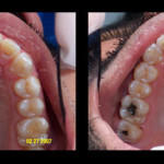 Cosmetic Dentist Hollywood Smile Gallery 11