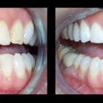 Cosmetic Dentist Hollywood Smile Gallery 15
