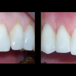 Cosmetic Dentist Hollywood Smile Gallery 17