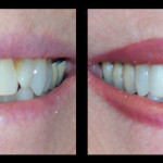 Cosmetic Dentist Hollywood Smile Gallery 19