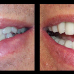Cosmetic Dentist Hollywood Smile Gallery 21