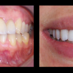 Cosmetic Dentist Hollywood Smile Gallery 24