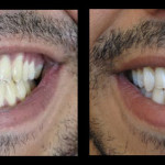 Cosmetic Dentist Hollywood Smile Gallery 26