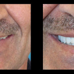 Cosmetic Dentist Hollywood Smile Gallery 30
