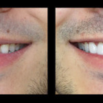 Cosmetic Dentist Hollywood Smile Gallery 31