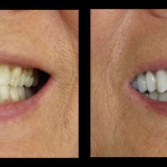 Cosmetic Dentist Hollywood Smile Gallery 32
